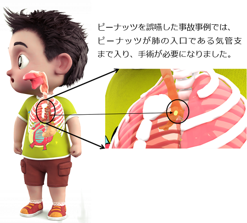 (画像)子どもの気管支にピーナツが詰まっている。(説明文)ピーナッツを誤嚥した事故事例では、ピーナッツがハイの入り口である気管支まで入り、手術が必要になりました。