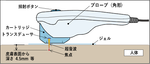 図:HIFUの仕組みのイラスト